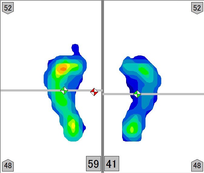 足圧バランス測定画像