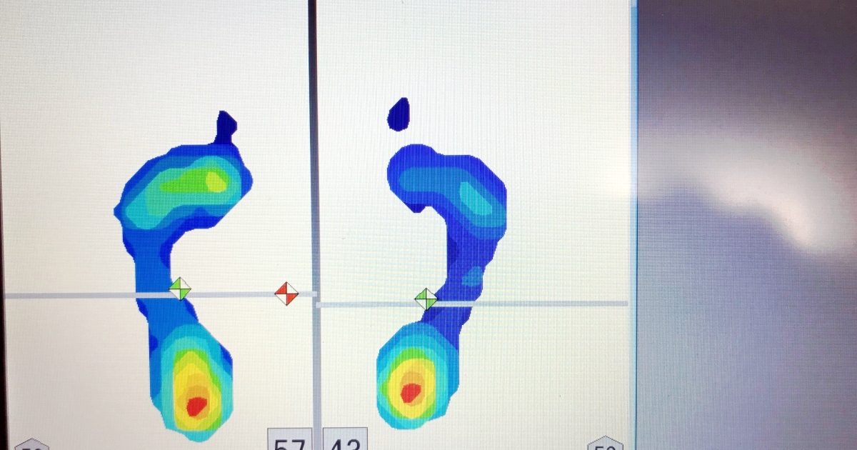 浮き指の足圧バランス画像