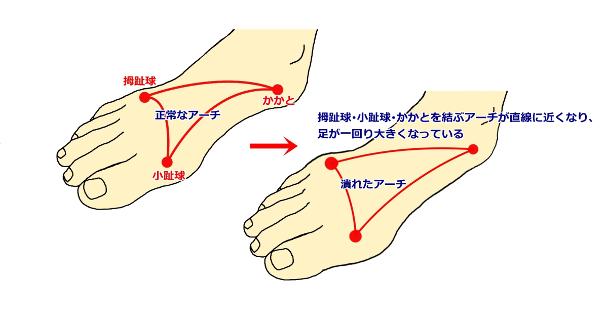 足裏アーチの画像