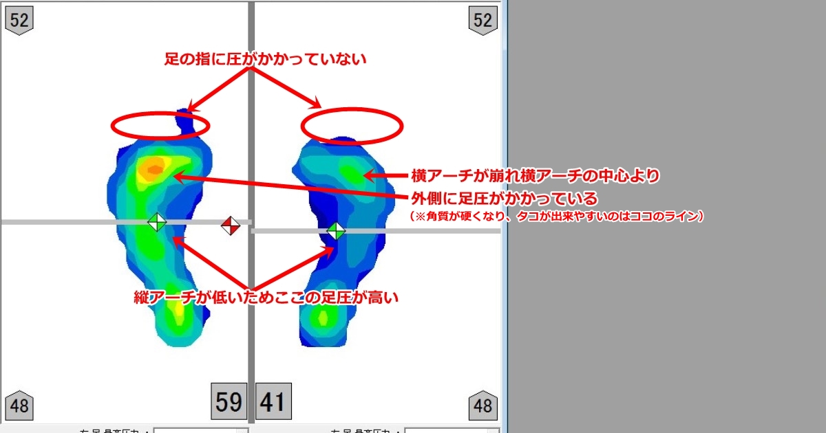 外反母趾、偏平足、タコが出来やすい人の足圧画像