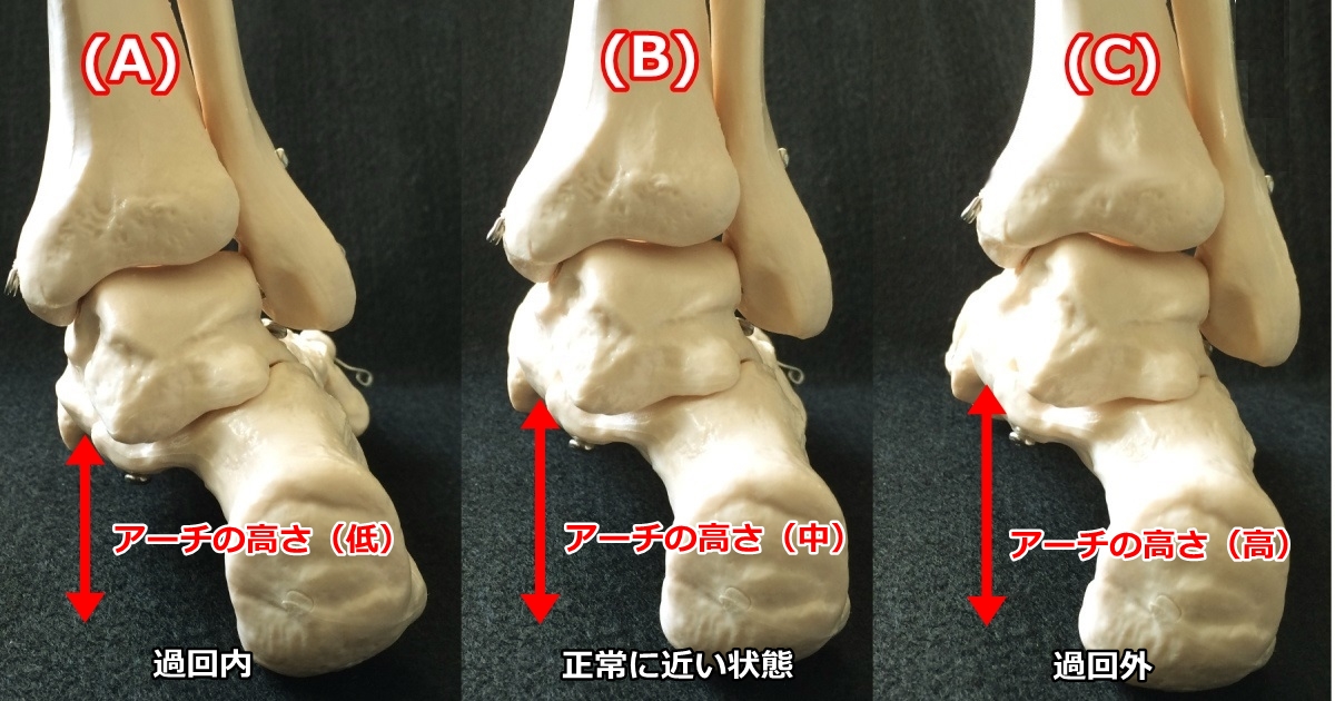 過回内、過回外、正常の足の傾き