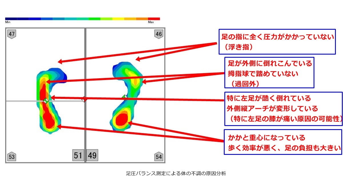 膝が痛い原因を足圧バランス測定から分析-足圧バランス測定による体の不調の原因分析