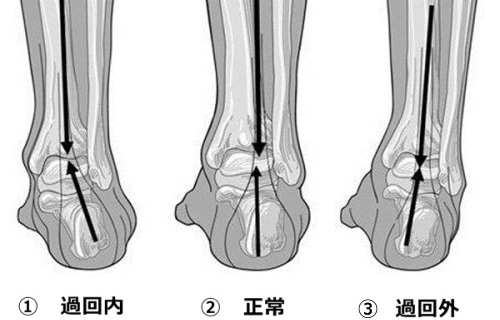 脚の傾き：過回内、過回外、正常、オーバープロネーション、オーバースピネーション