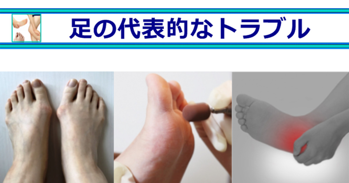 足の代表的なトラブル