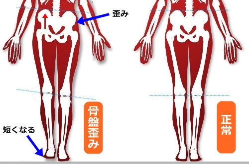 脚長差（左右の脚の長さの差）は骨盤の歪み