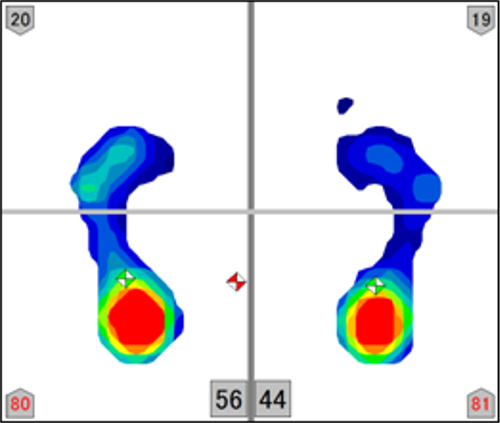 足圧測定画像「浮指・後ろ荷重」