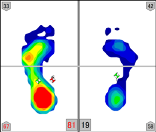 足圧測定画像その3