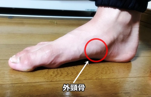 有痛性外頸骨の画像