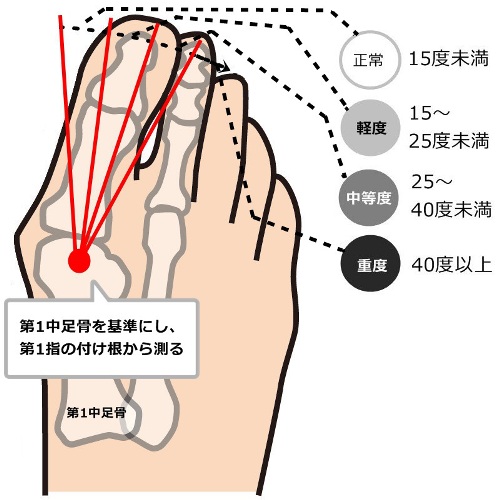 外反母趾の親指の角度による症状の程度の図解